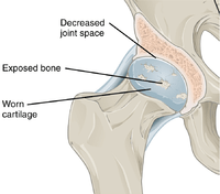 Annotated illustration of hip joint with ostoarthritis
