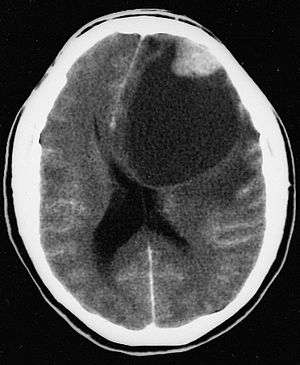 An image of a brain with pleomorphic xanthoastrocytoma.
