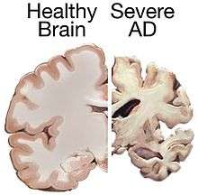 Comparison of the brain of a healthy human and of an Alzheimer's patient.