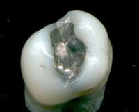 An extracted tooth displaying an amalgam metal restoration on the occlusal surface