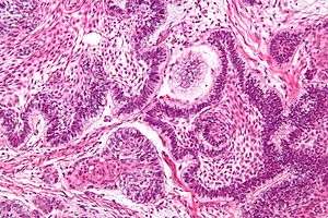  Ameloblastoma; Islands of cells with palisaded nuclei that have reverse polarization
