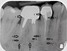 An X-ray explanation of bad root canal therapy