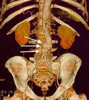 three white arrows pointing to an enlargement of the abdominal aorta