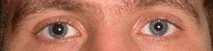 Right eye was instilled with tropicamide, leading to mydriasis and therefore anisocoria (unequal pupil size)