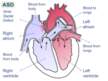 Diagram of the four chambers of the heart. There is a gap in the wall between the upper-left and upper-right chambers