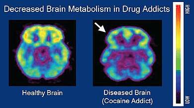 PET images showing brain metabolism in drug addicts vs controls