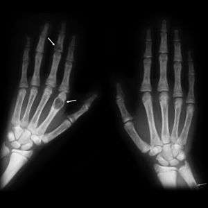 X-ray of two human hands, viewed with the palms facing downwards. Three light-gray malformations can be seen: one is present on the right-side of the right wrist, one is present three-quarters of the way up the middle finger of the left hand, and one is present in the first segment of the index finger of the left hand. White arrows have been added to the image to identify the tumors.