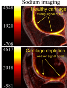 Na MRI image of healthy cartilage and depletion cartilage