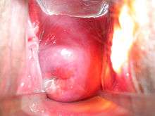 A adult woman's cervix viewed using a vaginal speculum