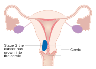 A diagram of stage II endometrial cancer