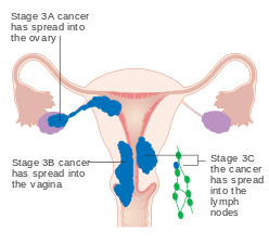A diagram of stage III endometrial cancer