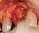 When mucosa is missing a free gingival graft of soft tissue can be transplanted to the area.