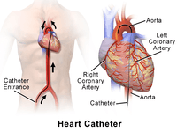 Heart Catheter