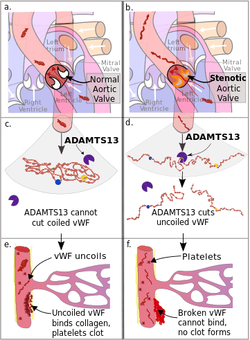 Diagram of the pathophysiology of Heyde's syndrome