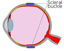 Diagram of an eye with a scleral buckle, in cross-section.