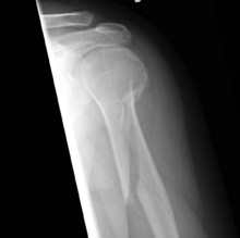 An x-ray image of a spiral fracture to the left humerus
