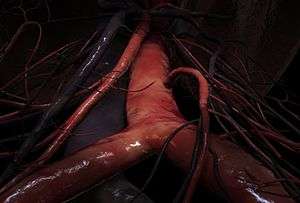 A 3D animation still of the junction between the common iliac artery and the lower abdominal aorta