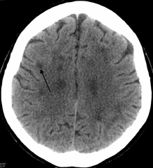 "CT showing a leukoencephalopathy "