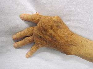 photograph of elderly hand depicting advanced rheumatoid arthritis