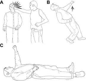 A schematic demonstrates the fencing response in three stages. First a man is struck across the face by another. Second he falls while his left arm begins to extend. Third he is on the ground unconscious with left arm raised in the air.