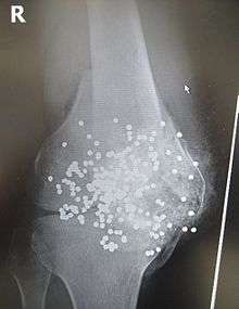 Radiograph of a close-range shotgun blast injury to the knee. Birdshot pellets are visible within and around the shattered patella, distal femur and proximal tibia.
