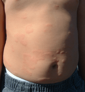 Raised, edematous, red skin lesions on the abdomen