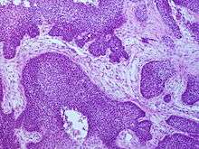 Appearance of basaloid pattern of squamous cell cancer under the microscope