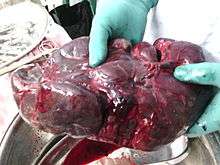 Surgically removed spleen of a child with thalassemia. It is about 15 times larger than normal.