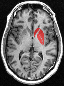 The striatum as seen on MRI. The striatum includes the caudate nucleus and the lentiform nucleus which includes the putamen and the globus pallidus