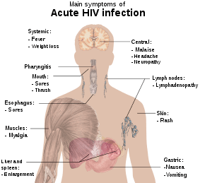 A diagram of a human torso labelled with the most common symptoms of an acute HIV infection