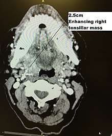 CT Scan of right tonsil cancer
